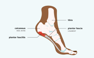 impact-of-high-heels-on-orthopedic-health