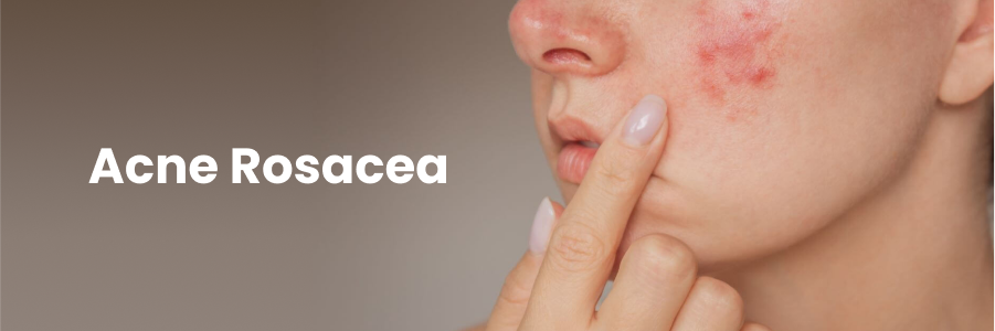 acne rosacea