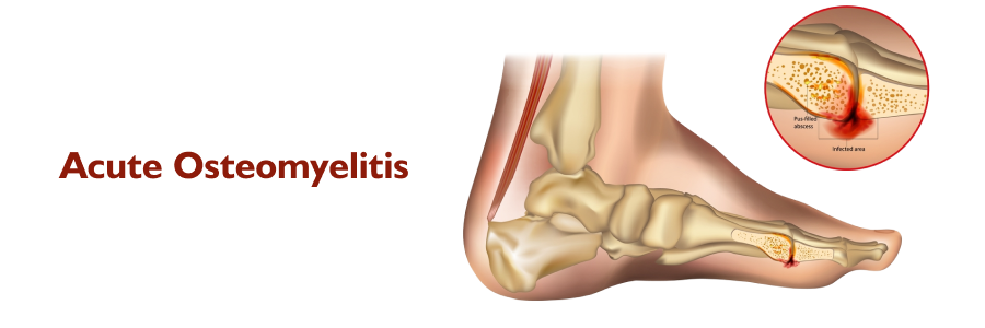 Acute Osteomyelitis