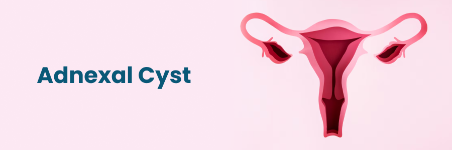 Adnexal Cyst