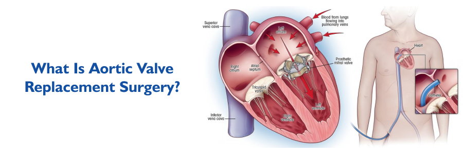 Aortic Valve Replacement Surgery In India