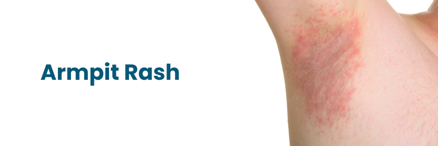 Armpit Rash: Causes, Symptoms, and Best Treatments