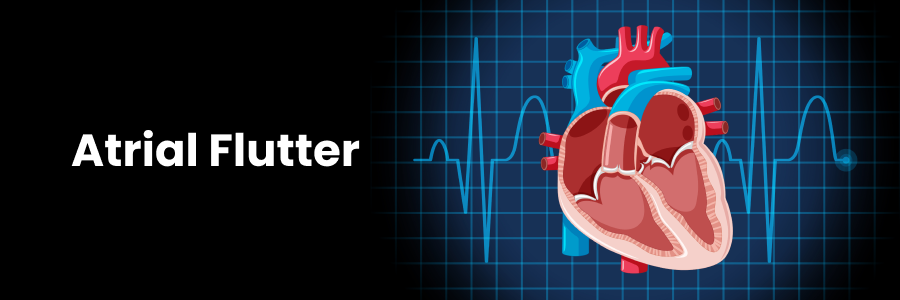 Atrial Flutter: Causes, Symptoms, Diagnosis, and Treatment