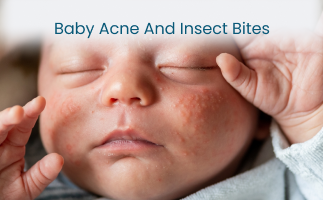 Baby Acne and Insect Bites Care Tips for Healthier Baby Skin