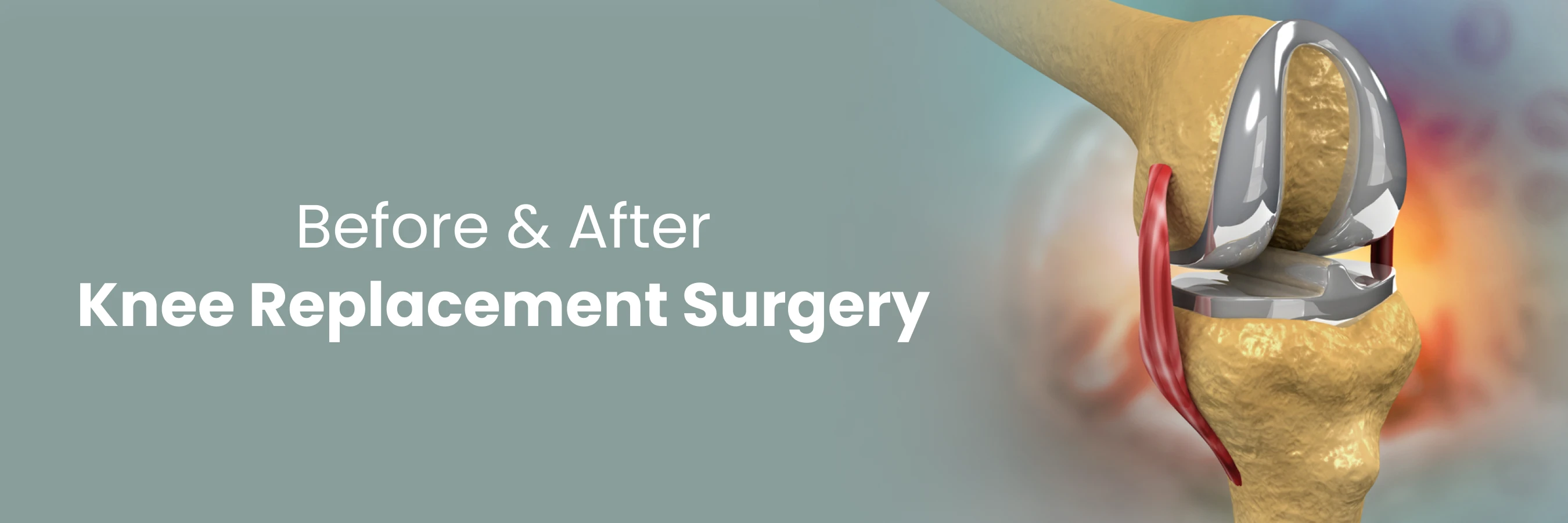 Knee Replacement Surgery : Before and After the Procedure