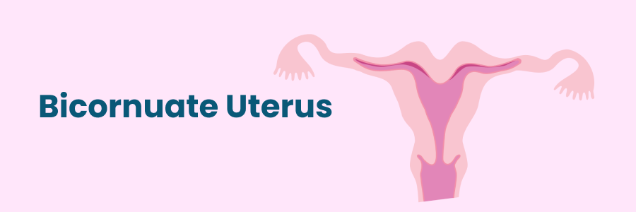 Bicornuate Uterus