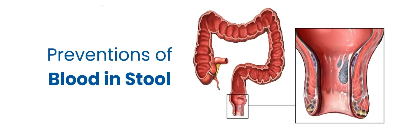 Blood in Stool