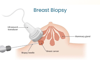 Breast Biopsy Types and Procedure