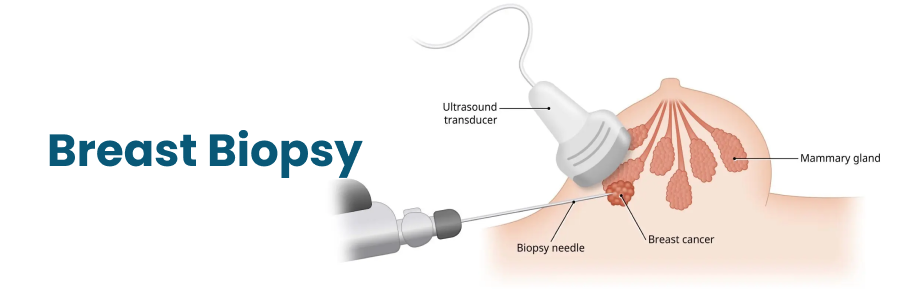 Breast Biopsy