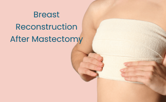 Breast Reconstruction After Mastectomy Options