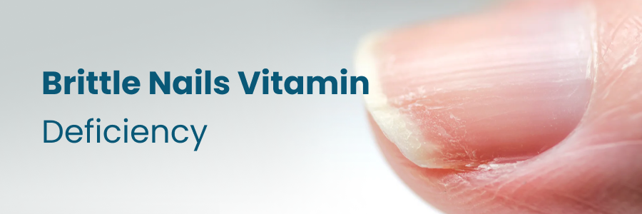 Brittle Nails Vitamin Deficiency