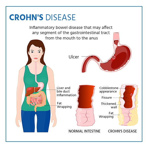 can crohn's disease be cured