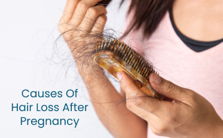 Causes  Management of Hair Loss After Pregnancy