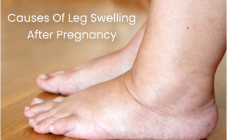 Causes of Leg Swelling After Pregnancy: Understanding and Management