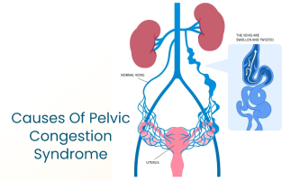 Pelvic Congestion Syndrome Symptoms Causes and Treatment