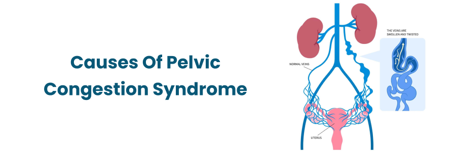 Causes Of Pelvic Congestion Syndrome