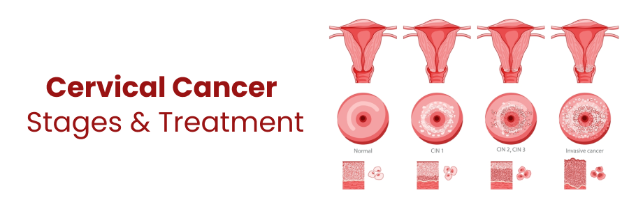 Treatment for Cervical Cancer for All Stages