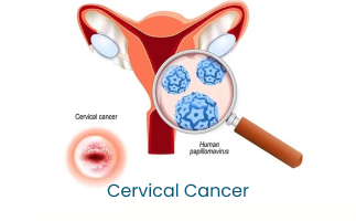 Cervical Cancer Early Detection and Prevention Tips for Women