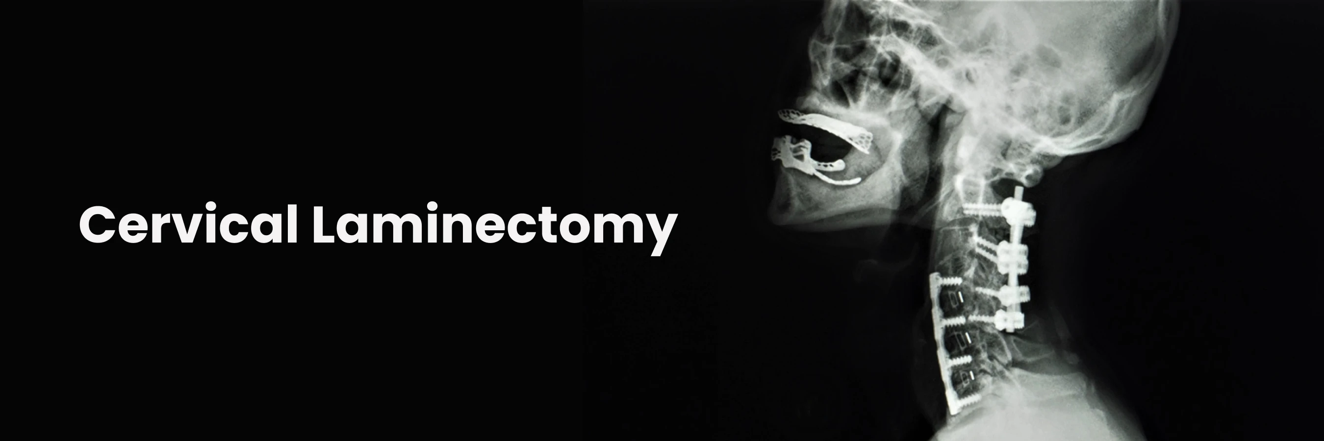 cervical laminectomy