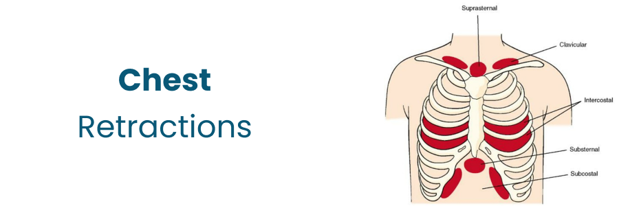 Chest Retractions