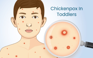 Chickenpox Symptoms to Watch for in Toddlers