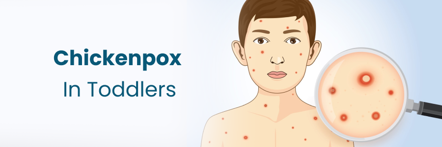 Chickenpox In Toddlers