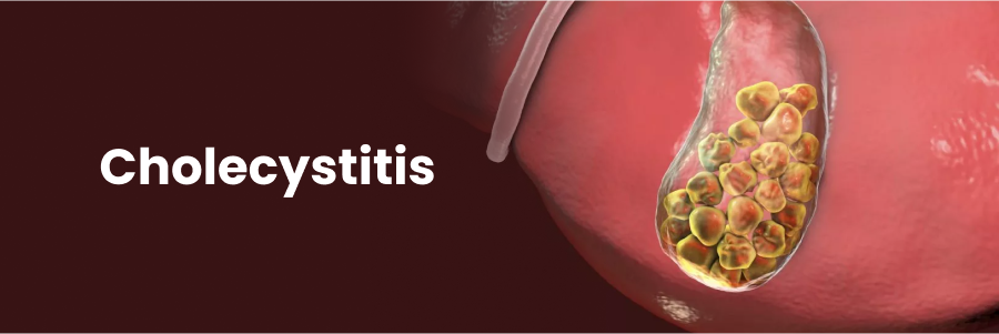 Cholecystitis