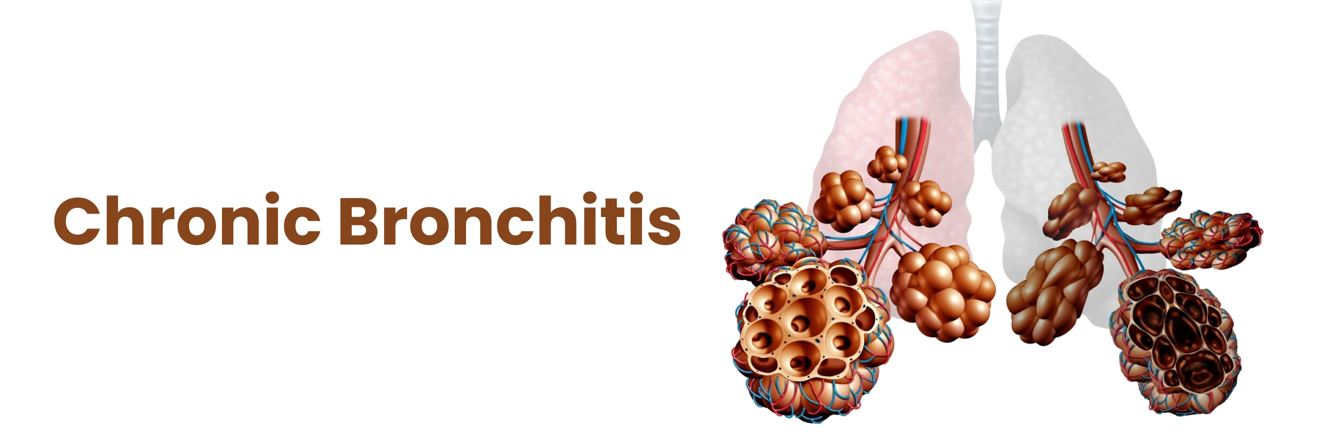 Chronic bronchitis