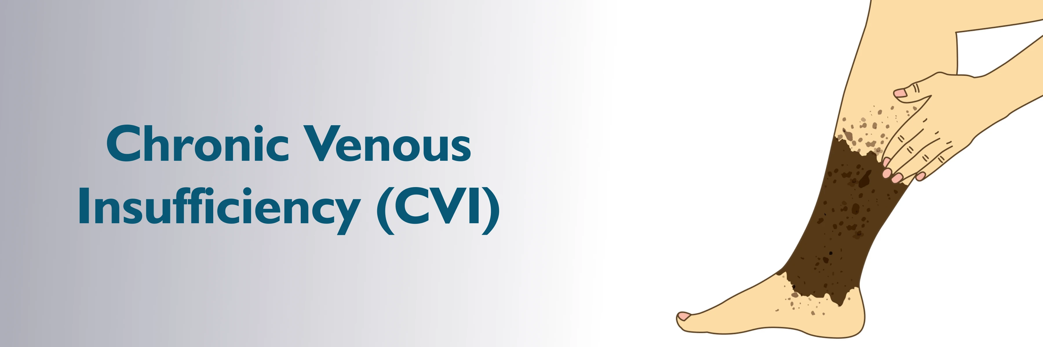 Chronic Venous Insufficiency (CVI)