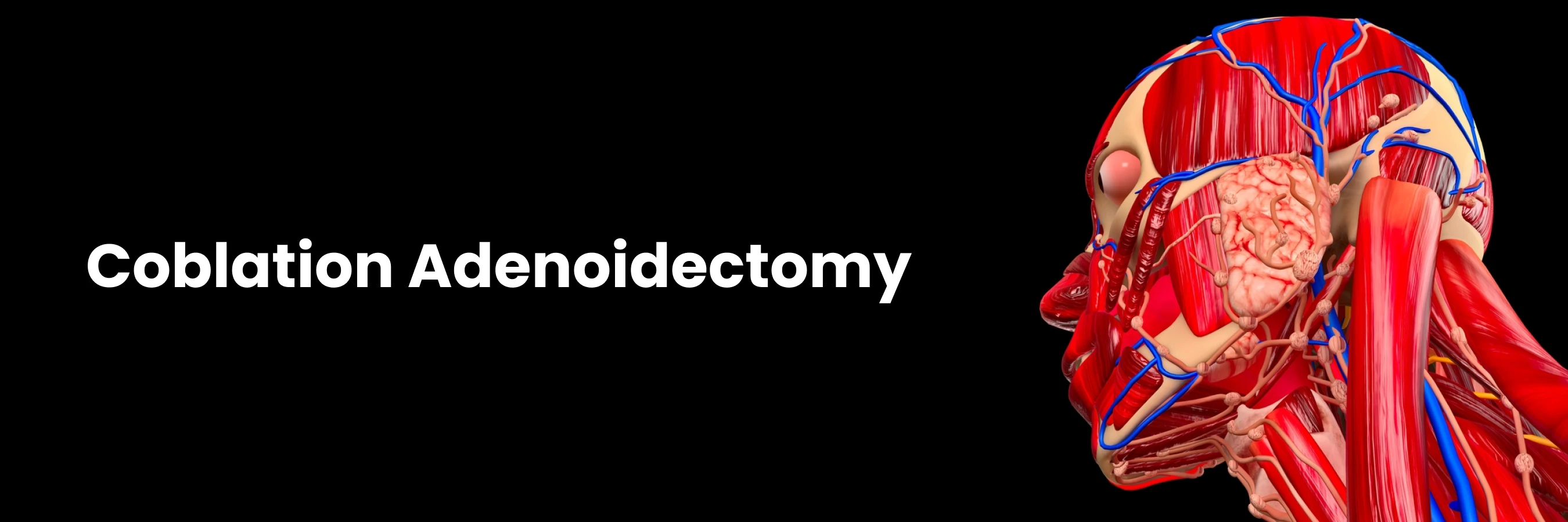 Coblation Adenoidectomy