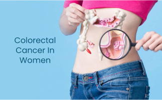 Colorectal Cancer in Women Symptoms Risk Factors