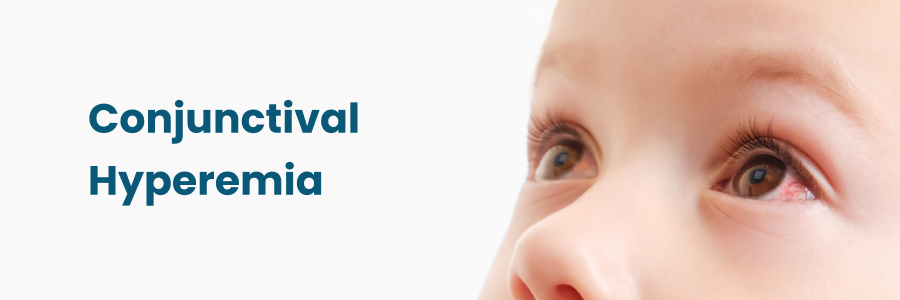 Conjunctival Hyperemia