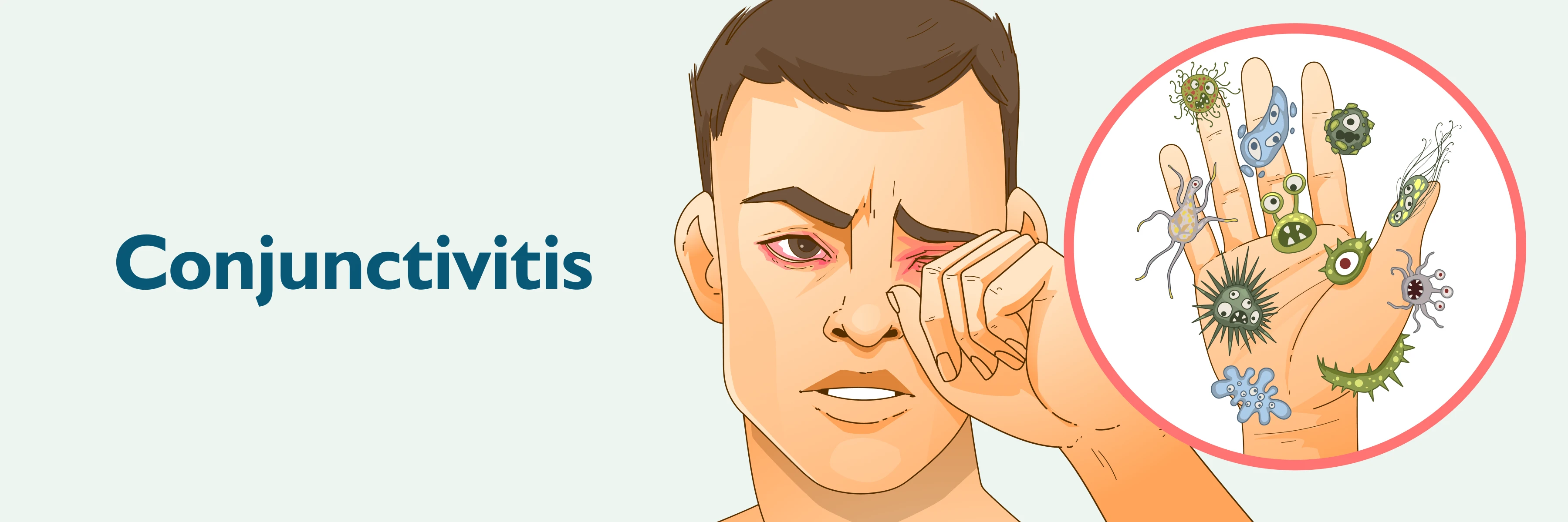 Signs and Symptoms of Pink Eye (Conjunctivitis)