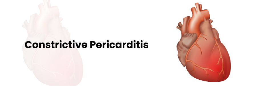 Constrictive Pericarditis