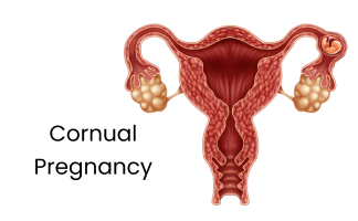 Cornual Pregnancy Symptoms and Treatment