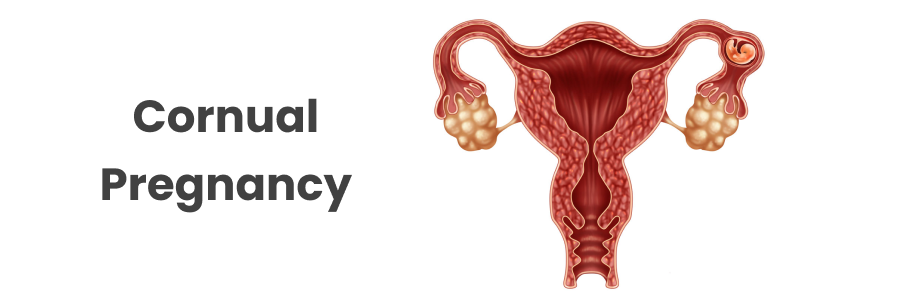 Cornual Pregnancy