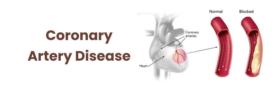 Coronary Artery Disease