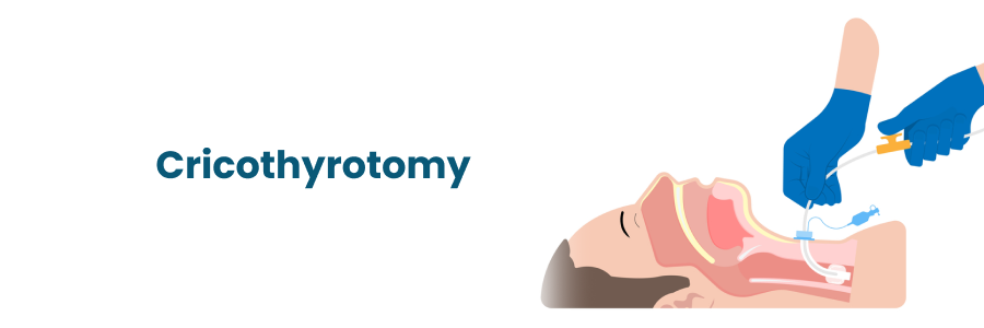 "Cricothyrotomy: Indications and Risks"