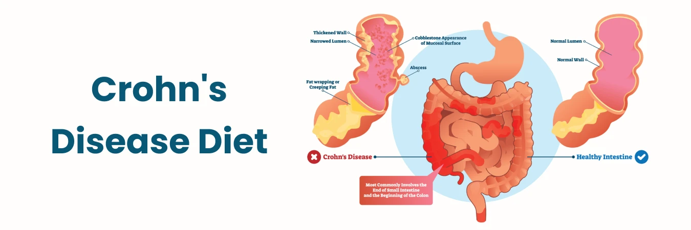 Crohn’s Disease Diet