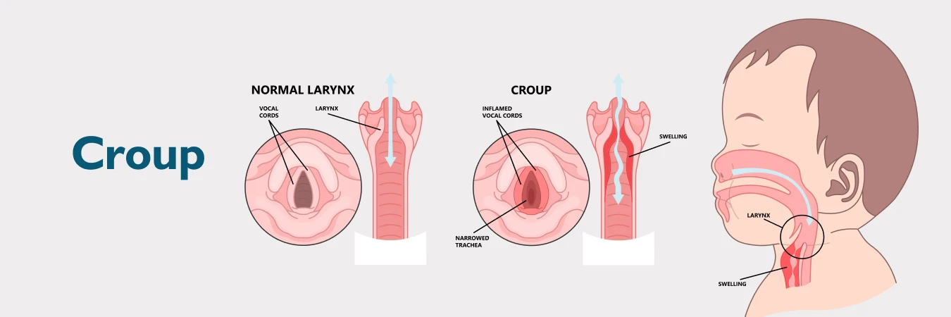 Croup