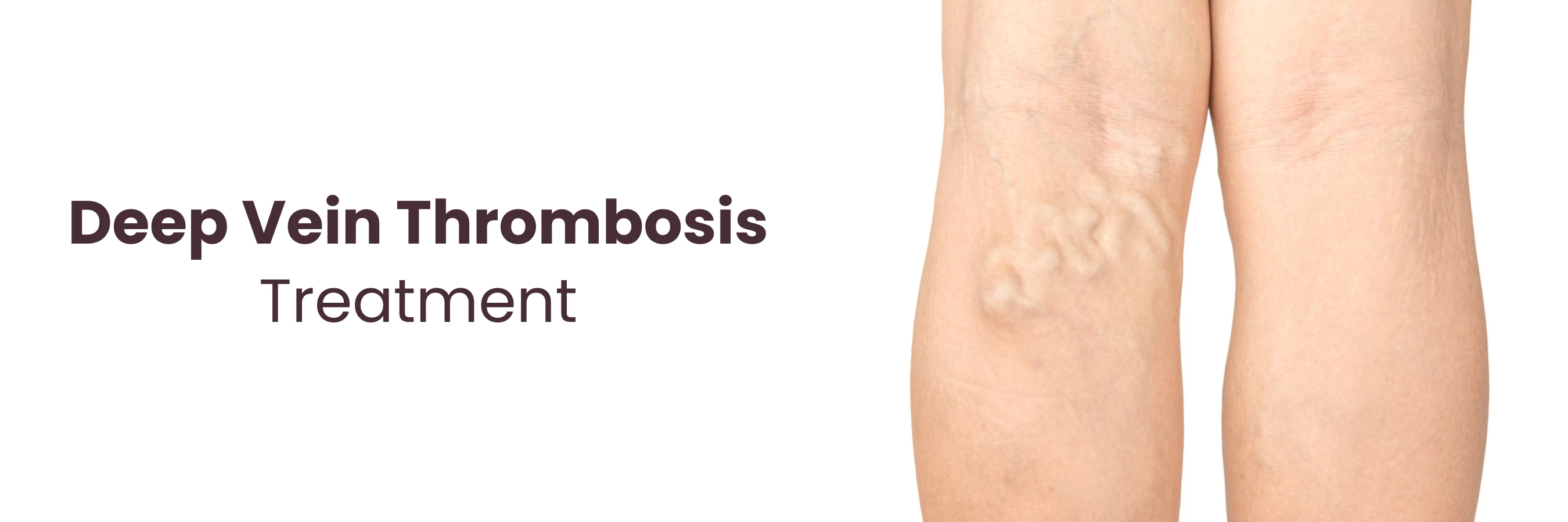 Deep Vein Thrombosis Treatment