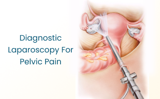 Diagnostic Laparoscopy for Pelvic Pain Procedure and Recovery