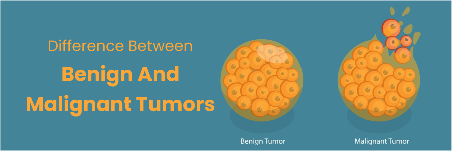 Characteristics & Treatments of Benign and Malignant Tumors