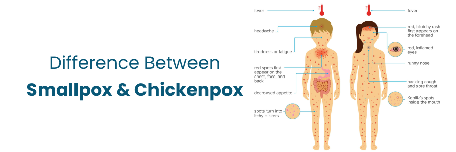 Difference Between Smallpox And Chickenpox