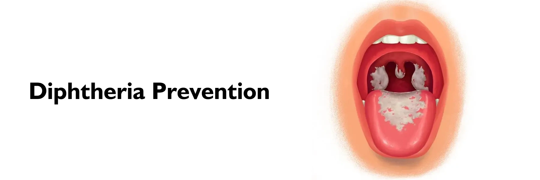 Diphtheria Prevention