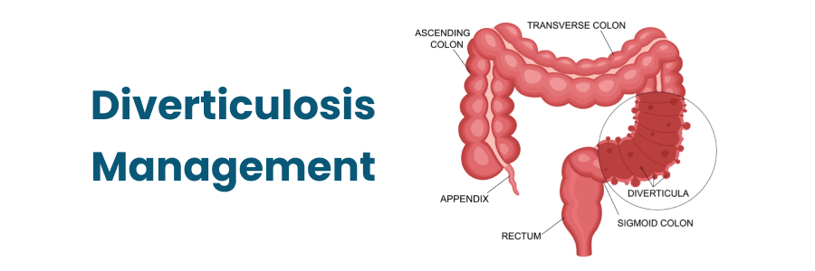 Diverticulosis Management in Begumpet