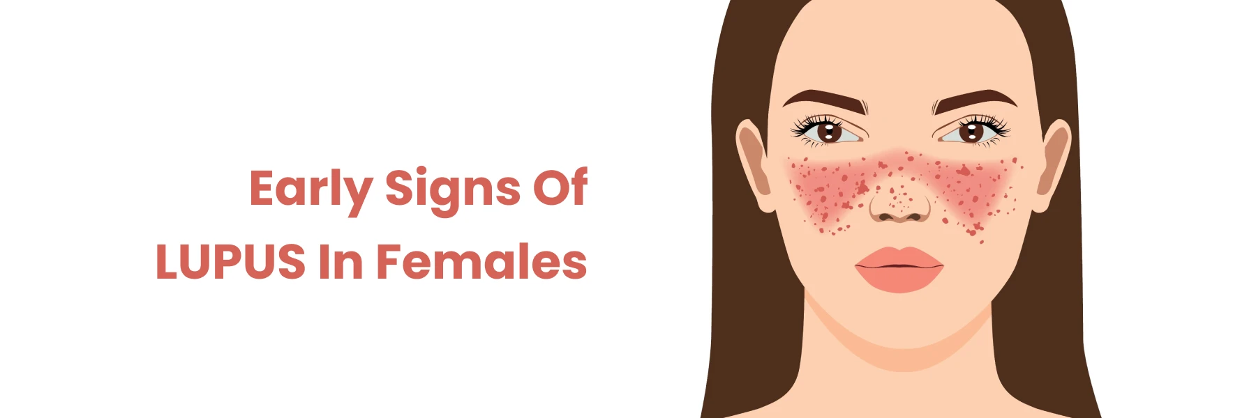 Lupus: Its Early Signs in Female, and its Importance in Diagnosis