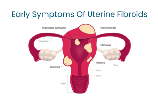 Identifying the Early Symptoms of Uterine Fibroids