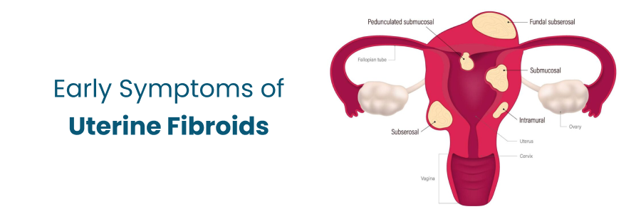 Early Symptoms of Uterine Fibroids