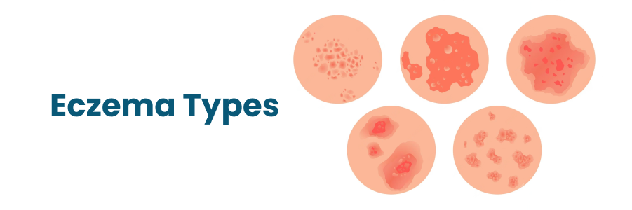 Eczema Types